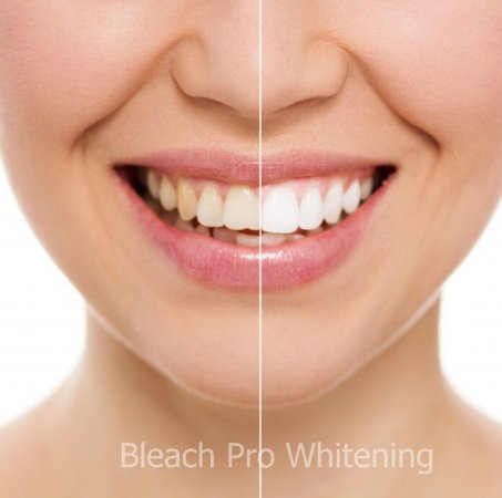 Bleaching(ağartma)