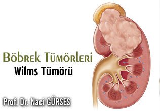 Böbrek tümörleri – wilms tümörü ( nefroblastom )