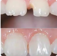 Bonding (dental bonding)