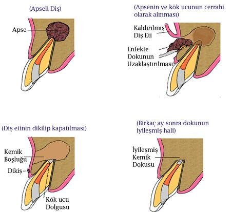 Çekim kararı alınan diş kurtarılabilir mi ?