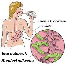 Çocuklarda mide mikrobu (helicobacter pylori)