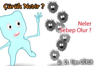 Çürük nedir ve neden olur ?