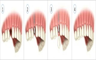 Diş implantı tedavi süreci