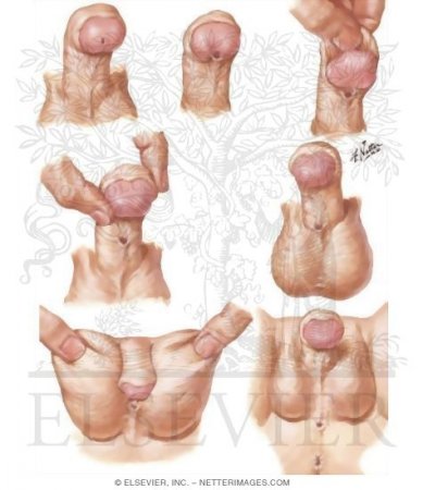 Hypospadias