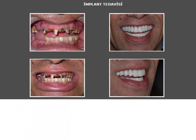 İmplant nedir? İmplant kimlere uygulanır?