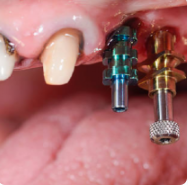 Implant nedir? Implant tedavisi ne kadar sürer? Herkes yaptırabilir mi? Vücut tarafından reddedilme riski var mıdır? Nelere dikkat etmek gerekir? Yapılan ımplant tedavisinin ömrü ne kadardır?
