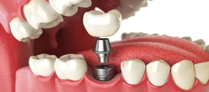 İmplant nedir, neden implant yaptırmalısınız?
