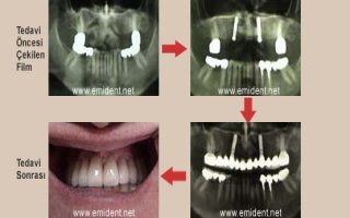 İmplant ”sorular ve cevaplar”