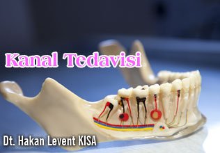 Kanal tedavisi