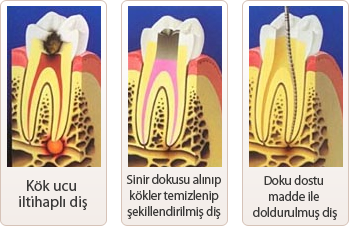 Kanal tedavisine neden ihtiyacım var ?
