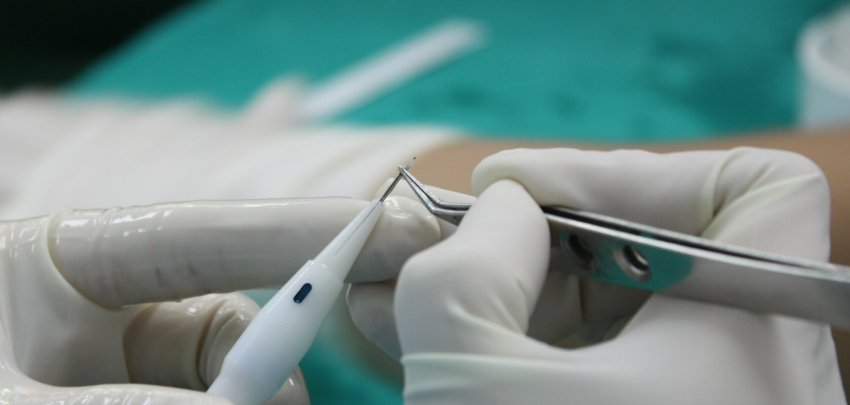 Neden implanter pen tekniği ile saç ektirmeliyim?