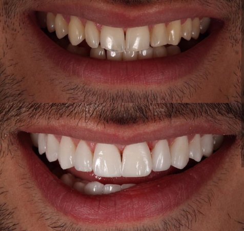 Zirkonyum diş nedir ? Gülüş estetiği nasıl sağlanır ?