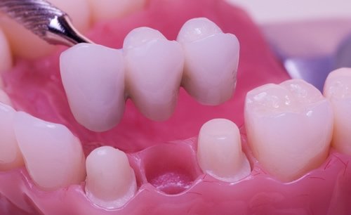 Zirkonyum protez nedir? Nasıl yapılır?